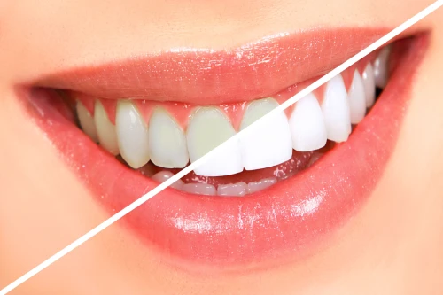 teeth whitening treatment in pune