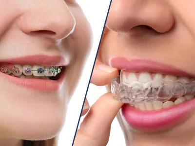 Comparing Clear Aligners to Traditional Braces Pros and Cons