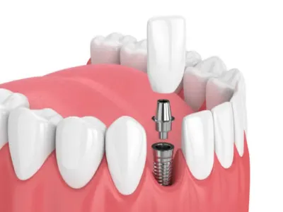 Common Myths and Misconceptions About Dental Implants
