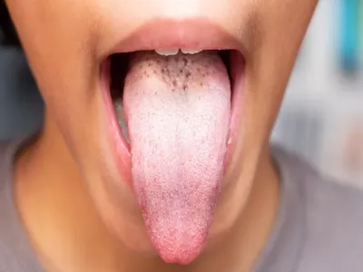 Unveiling the Mystery of White Tongue Causes, Remedies, and More