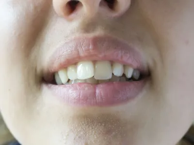 Understanding Why Your Teeth Shift Unevenly