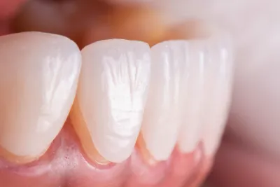 Dental Laminates What Are They and How Do They Work