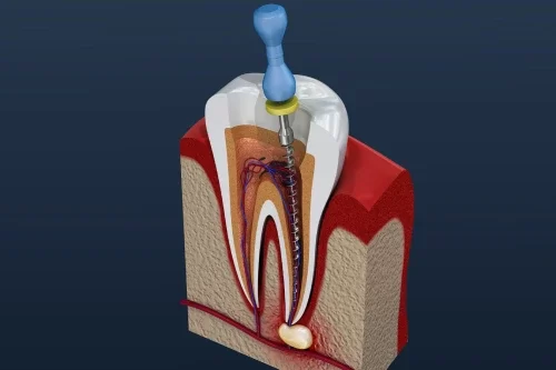 Root Canal Treatment in Koregaon park